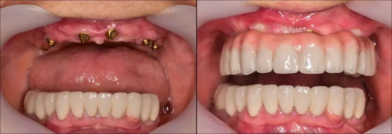 Dental implants