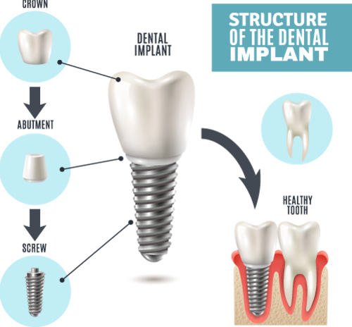 Structure of a Dental implant illustration