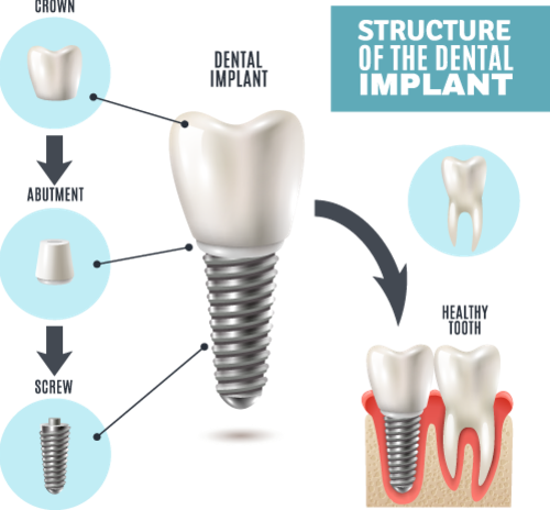 Structure of a Dental implant illustration